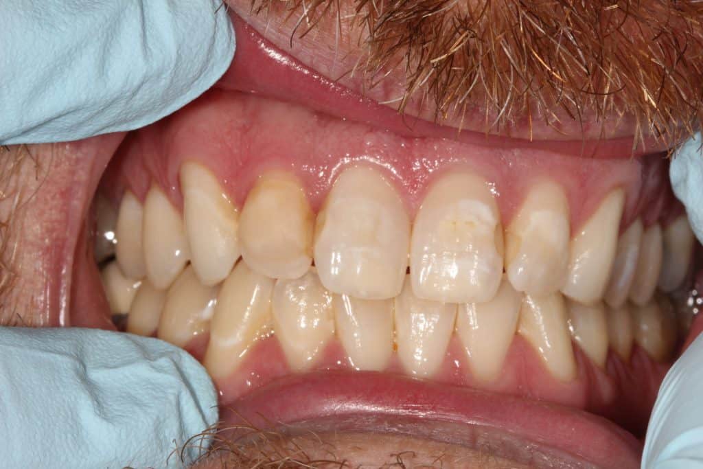 Crowns Before